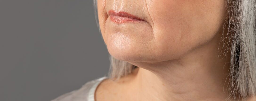 Rughe della marionetta: cause e come possono essere trattate