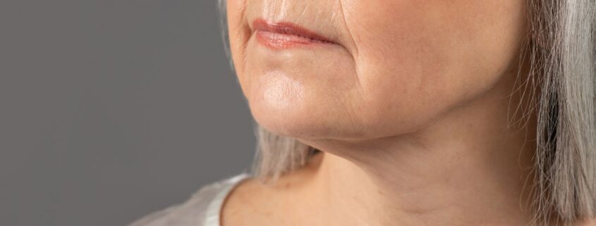 Rughe della marionetta: cause e come possono essere trattate